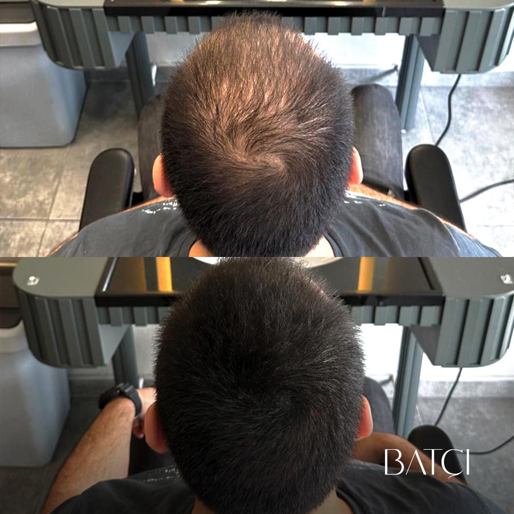 Tinte Profesional Especial Cubre Calvicie y Canas